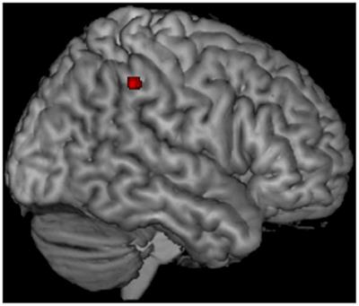 Profiling morphologic MRI features of motor neuron disease caused by TARDBP mutations